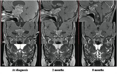 Giant Prolactinoma Causing Hydrocephalus and Intracranial Hypertension as First Manifestations of Multiple Endocrine Neoplasia Type 1